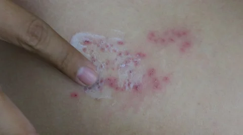 Raised red bumps and blisters on skin with white cream selective focus on finger Stock Footage 62680146