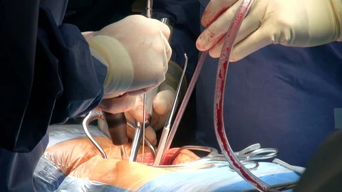 Rare surgery on human spine with different surgical tools Video stock 115601390