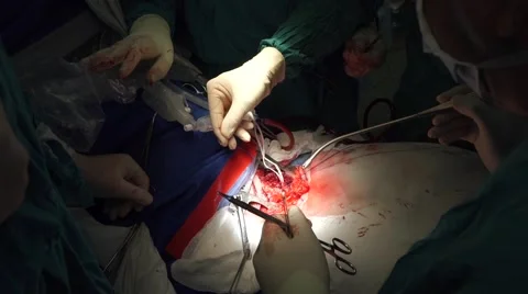 Rare surgery on trachea Stock Footage 61628696