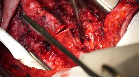 Rare surgery on trachea Stock Footage 61628860