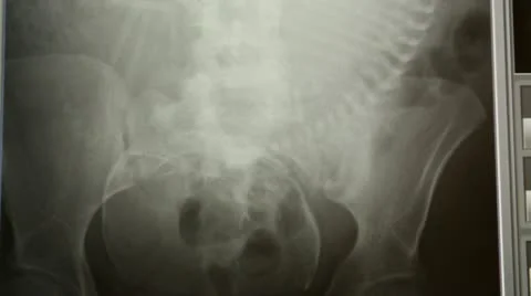 Rare xray of a full term baby or fetus in utero Stock Footage