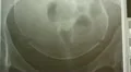 rare xray of a full term baby fetus in utero pelvis Video HD