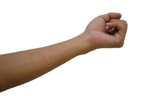 Rash in the arm Foto stock