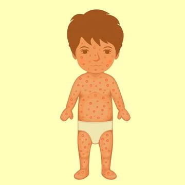 Rash, chicken pox Stock Illustration
