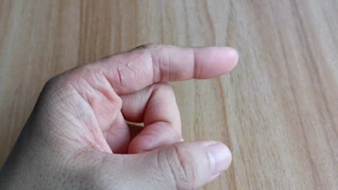Rashes Allergens on Hands Atopic Dermatitis Stock Footage 240710914