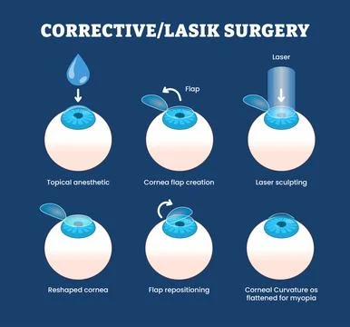 Raw-REVCorrective Laser Eye Surgery or Lasik Surgery Procedure Progress for.. Stock Illustration