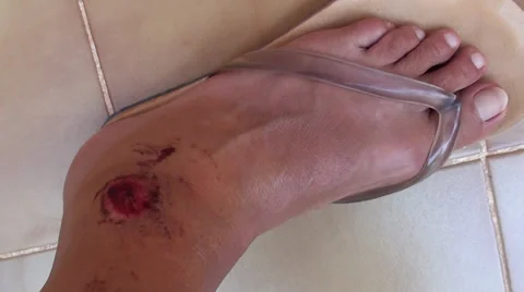 Raw wounds on ankle 2 Stock Footage 27786470