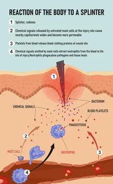 Reaction of the body to a splinter. Inflammatory process in wound healing Stock Illustration