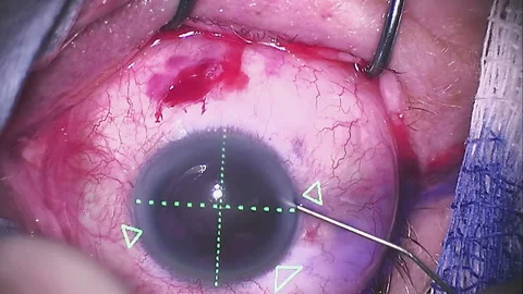 Real eye surgery. Close-up from microscope V1 Stock Footage 124300744
