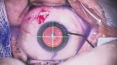 Real eye surgery. Close-up from microscope V4 Stock Footage 124305099