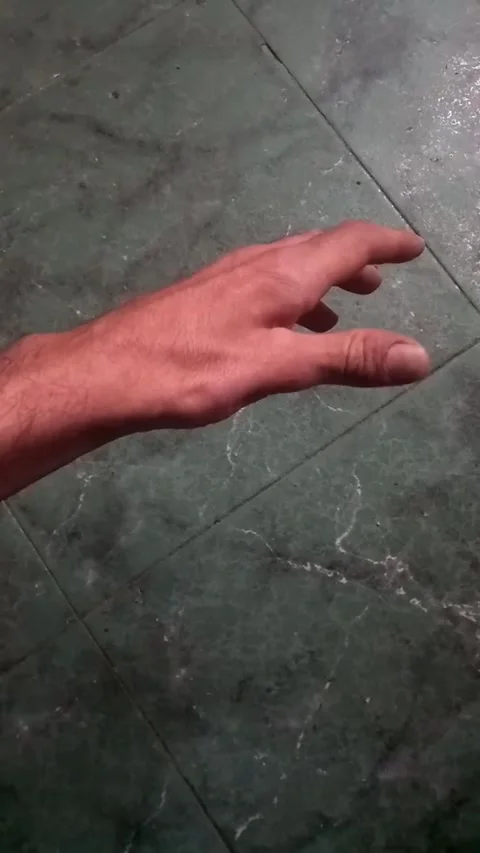 Real Hand Movement With Physical Disability – Authentic Footage Stock Footage 313381774
