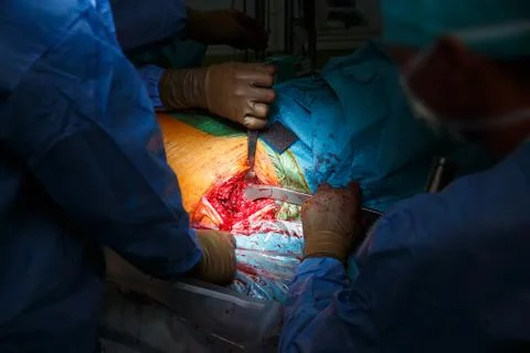 Real hip replacement surgery in progress Stock Photos