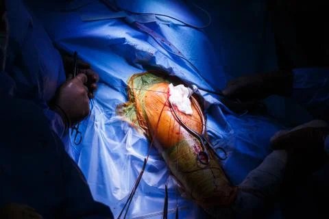 Real shoulder surgery in progress Stock Photos
