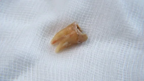 Real time footage of a Damaged molar tooth on a white gauze Stock Footage 107320802