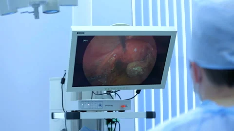 Real Time Surgeon Performs Tumor Removal Surgery. Organs. Laparoscopic Surgery Stock Footage 164634911