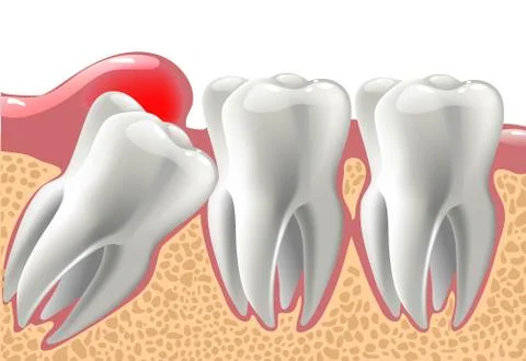 Realistic 3D teeth, and wisdom tooth problems Stock Illustration