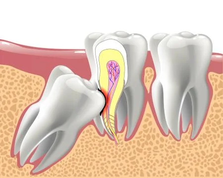 Realistic 3D teeth, and wisdom tooth problems Stock Illustration