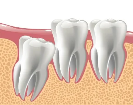 Realistic 3D teeth, and wisdom tooth problems Stock Illustration