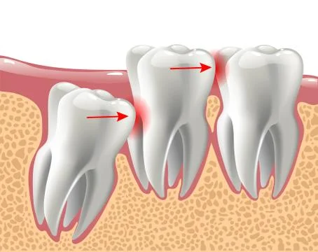 Realistic 3D teeth, and wisdom tooth problems Stock Illustration