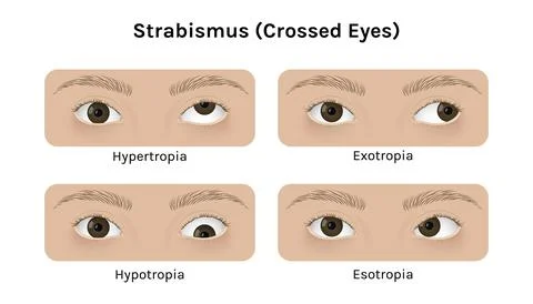 Realistic human eyes with strabismus vector illustration design. Stock Illustration