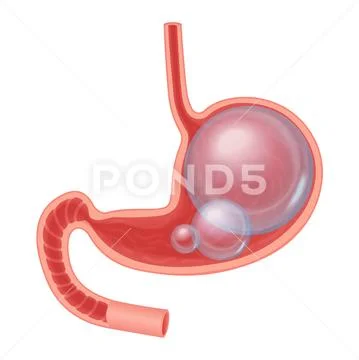 Realistic medical illustration of Abdominal bloated stomach isolated Stock Illustration