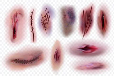 Realistic scars. Wound, surgical stitches and bruis, skin cuts. Bloody wounds Stock Illustration