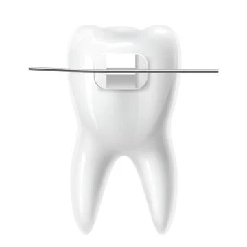 Realistic tooth with braces. White 3d isolated teeth, bite correction in Stock Illustration