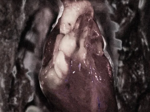 Reanimated Heart Stock Footage 35053705