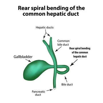 Rear spiral bending of the common hepatic duct. Pathology of the gallbladder Stock Illustration