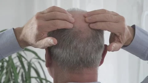 Rear view older man with bald patches on scalp, showing signs alopecia and .. 库存影片 306091253