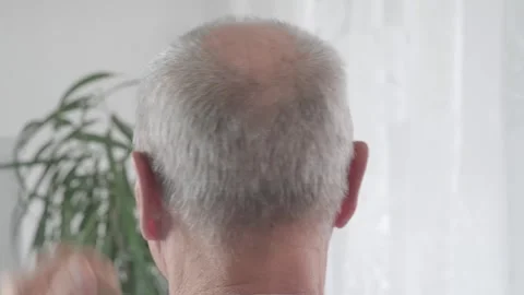 Rear view older man with bald patches on scalp, showing signs alopecia and .. 库存影片 310518162