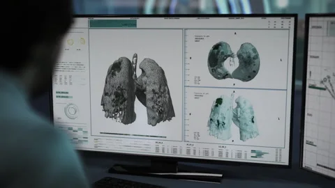 The reason for the serious lung damage was identified as Covid-19 Pneumonia. Stock Footage 268990580