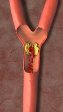 Recombinant Clot Dissolving Enzyme Animation Stock Illustration