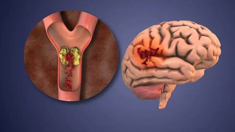 Recombinant Therapy for Breaking Down Blood Clots Illustration