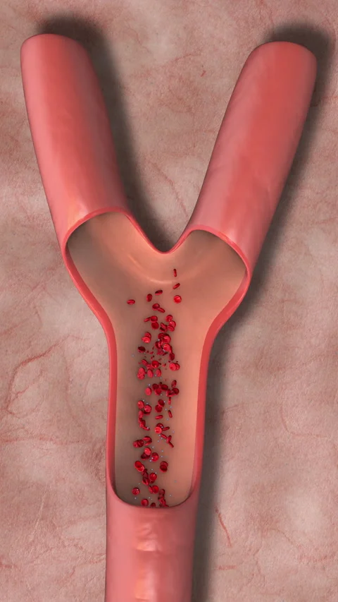 Recombinant Tissue Plasminogen Activator for Clot Dissolution Stock Footage 334052751
