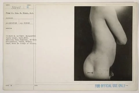RECORD DATE NOT STATED  Charles N. Macknit impacted by flea bites, capture... 写真素材