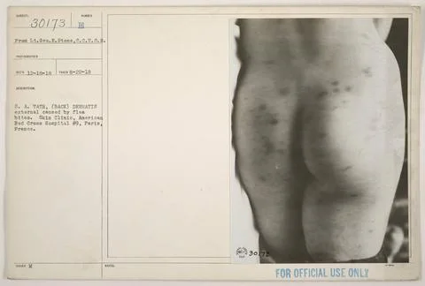 RECORD DATE NOT STATED  Image of S. A. Tath, a soldier with dermatitis cau... Stock Photos