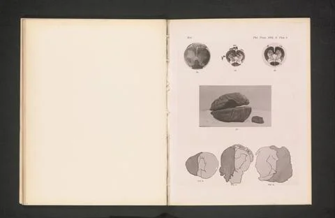 RECORD DATE NOT STATED  Three sections of damaged spinal cords, three repr... Stock Photos