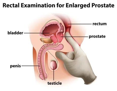 Rectal Examination for Enlarged Prostate Illustrazione stock