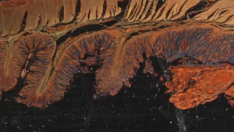 Rectum carcinoma tissue under the microscope Stock Footage 292282570