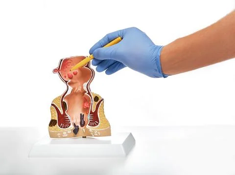 Rectum pathologies on an anatomical model, isolated on white. Treatment of re Stock Photos