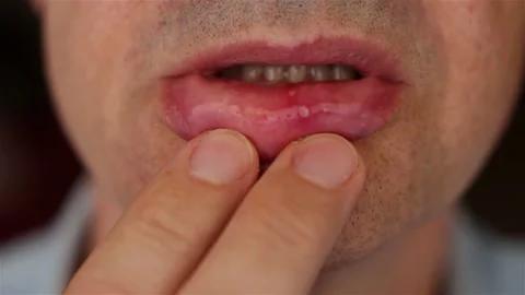 Recurrent aphthous ulcers or canker sores, sore lip. Aphthous stomatitis,  b Stock Footage 161022333