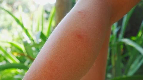 Red bite mark on the leg. Itching and inflammation. Scratch the wound with yo Foto stock