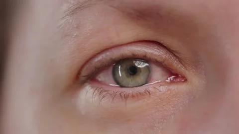 Red blood eye of woman affected by conjunctivitis or after flu, cold or allergy Stock Footage 276234316