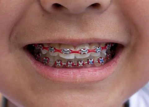 Red braces Fotos de archivo