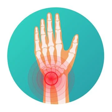 Red circle pain localization in human hand wrist injury, skeleton, joints and Stock-Illustration