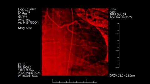 Red colored angiogram of heart vessels | Cardiovascular angiography Stock Footage 89752288