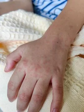 Red dots under skin during viral fever, close-up Stock Photos