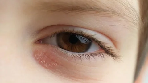 Red dry scaly patch of dermatitis under childs eye slow motion Stock Footage 330069174