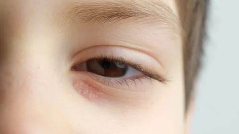 Red dry scaly patch of dermatitis under childs eye. Vídeos de archivo 330951519